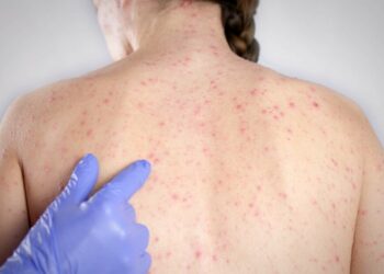 Focar de rujeolă în raionul Sîngerei. ANSP îndeamnă populația să se vaccineze