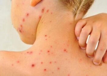 Rujeola face victime în România. A decedat un copil de 10 luni, nevaccinat antirujeolic