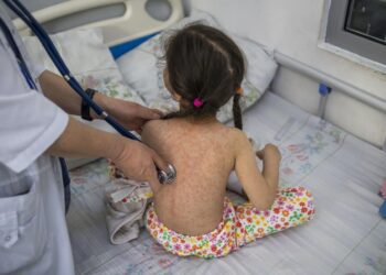 Ministra Sănătății avertizează părinții că rujeola a revenit în regiune și îi îndeamnă să vaccineze copiii